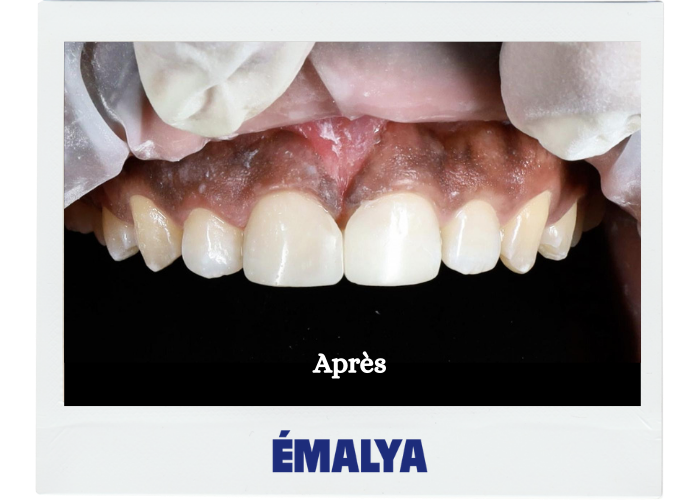 Après traitement ÉMALYA