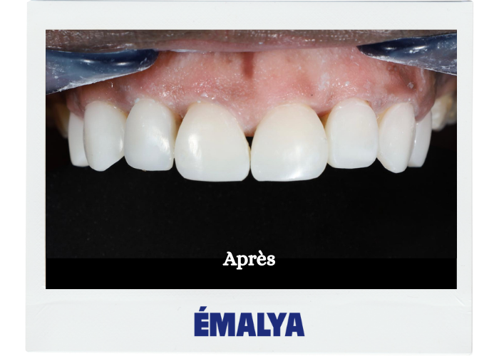 Après traitement ÉMALYA