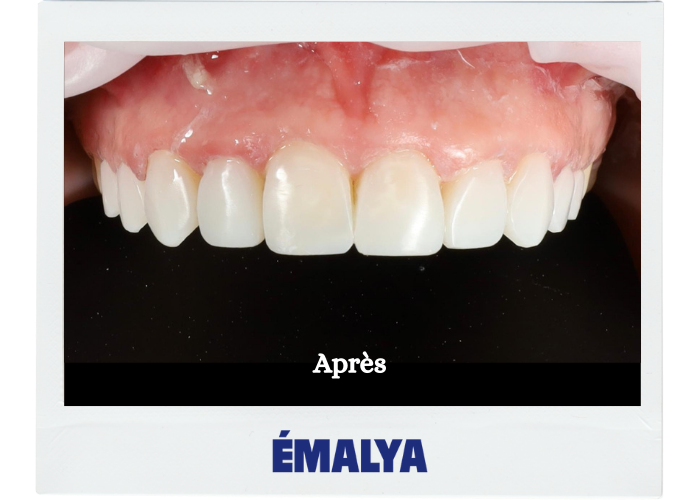 Après traitement ÉMALYA