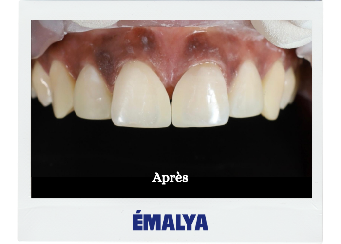 Après traitement ÉMALYA