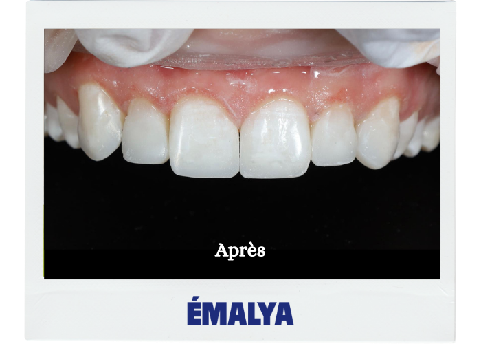 Après traitement ÉMALYA