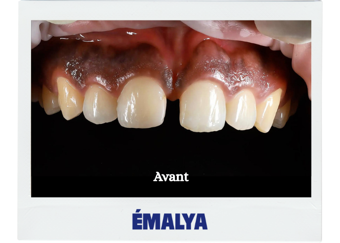 Avant traitement ÉMALYA