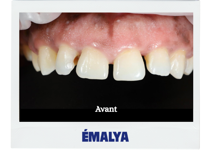 Avant traitement ÉMALYA