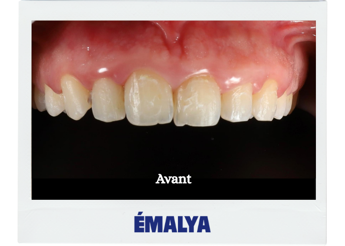 Avant traitement ÉMALYA