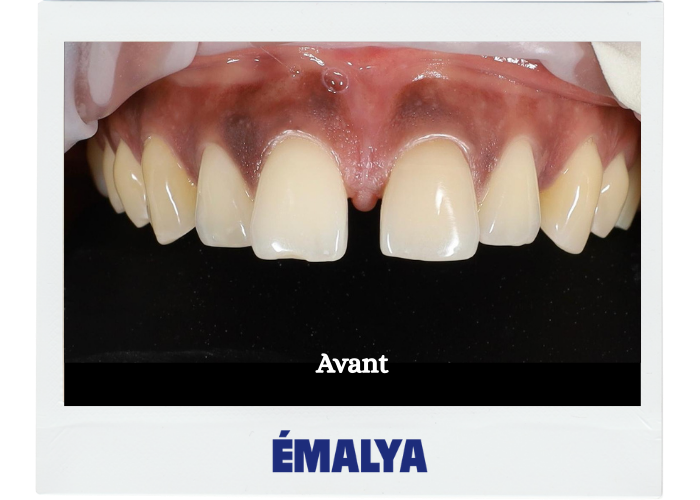 Avant traitement ÉMALYA