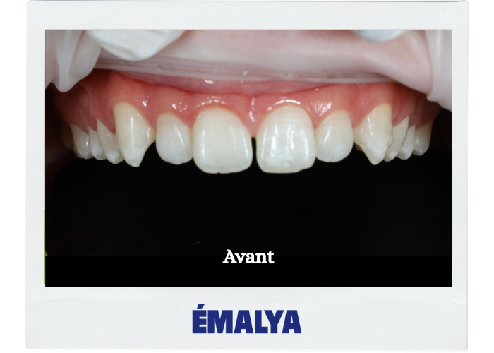 Avant traitement ÉMALYA